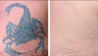 Eraser Clinic Laser Tattoo Removal image 1
